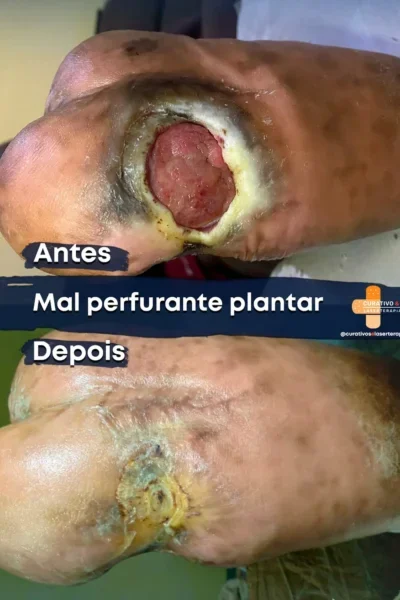 Resultado de tratamento de ferida