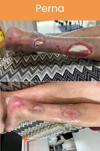 Resultado de tratamento de ferida