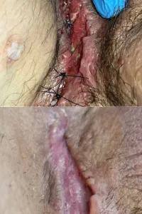 Resultado de tratamento de ferida