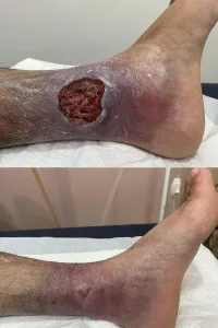 Resultado de tratamento de ferida