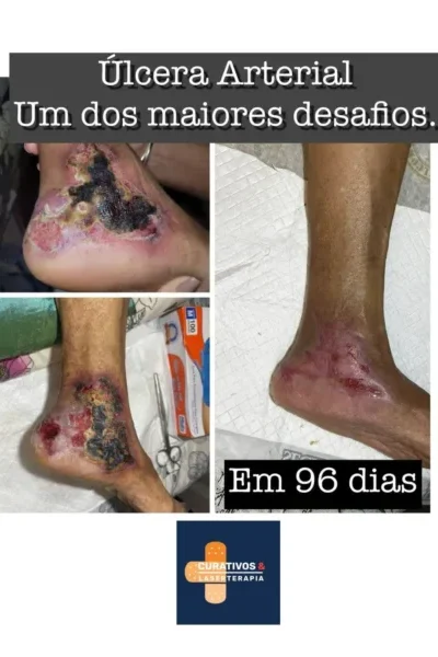 Resultado de tratamento de ferida