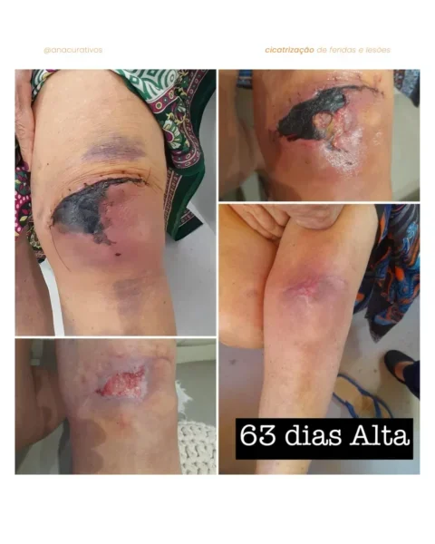 Resultado de tratamento de ferida