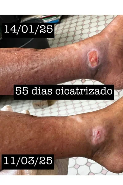 Resultado de tratamento de ferida