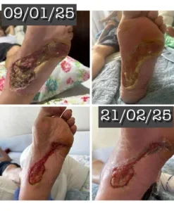 Resultado de tratamento de ferida
